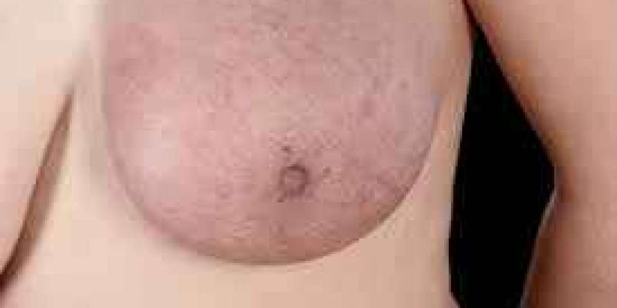 Breast cancer