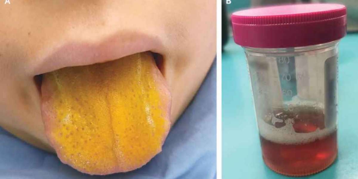 Boy's bright-yellow tongue was a sign of rare disorder