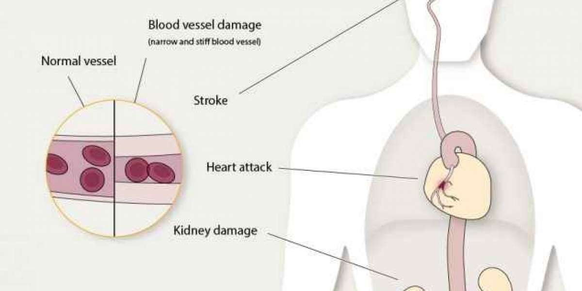 High blood pressure