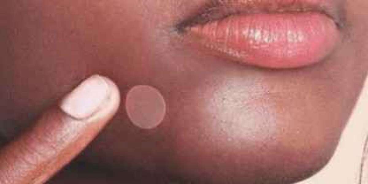 What Causes The Appearance Of Pimples?