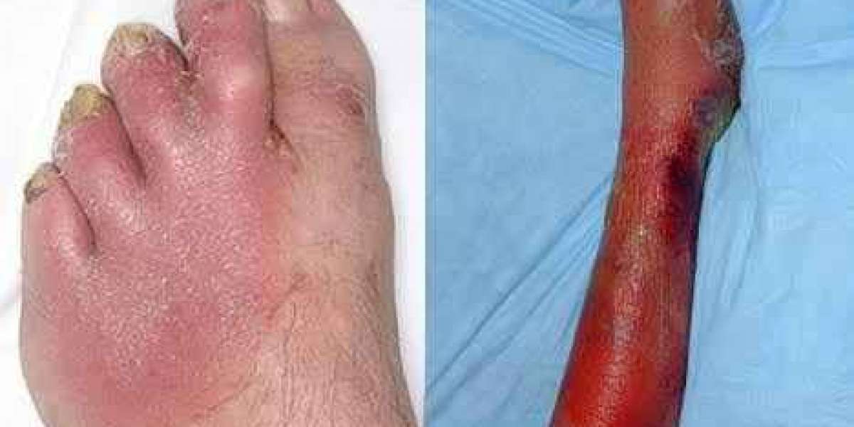 Cellulitis what it is the causes, symptoms, complications, diagnosis and treatment.