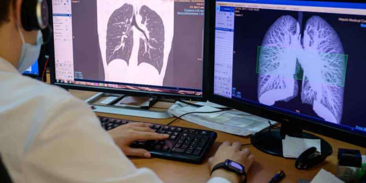Early CT scans deliver huge fall in lung cancer deaths, study shows