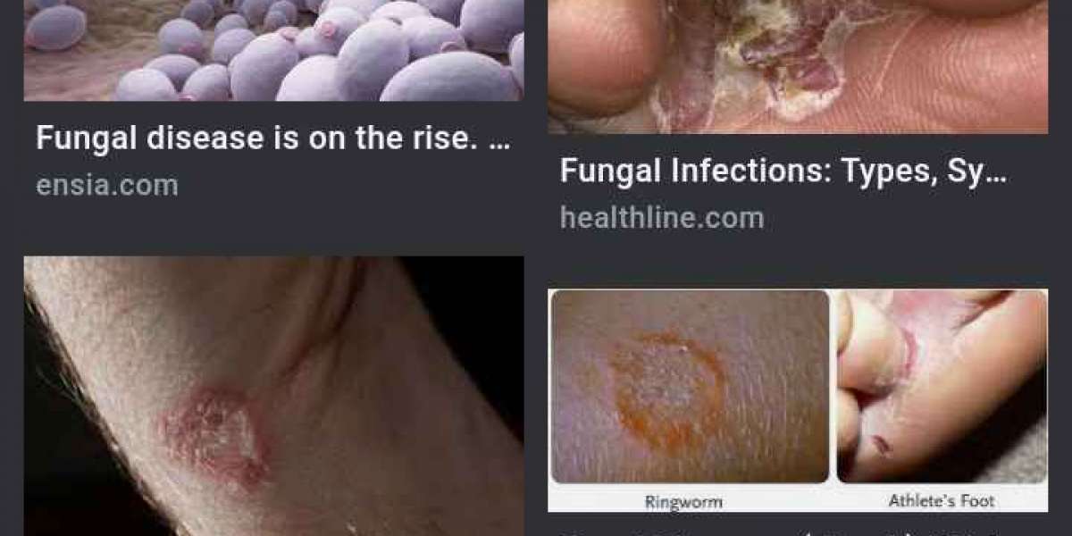 FUNGAL DISEASES(PREVENTION AND TREATMENT)