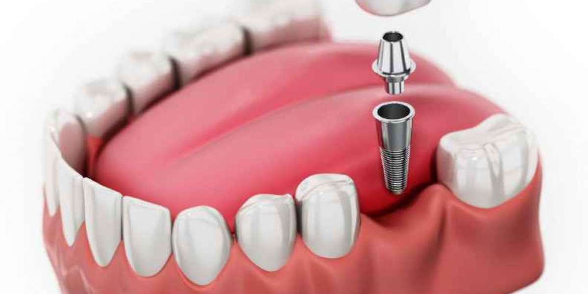 Dental Implants Versus Crowns and Bridges