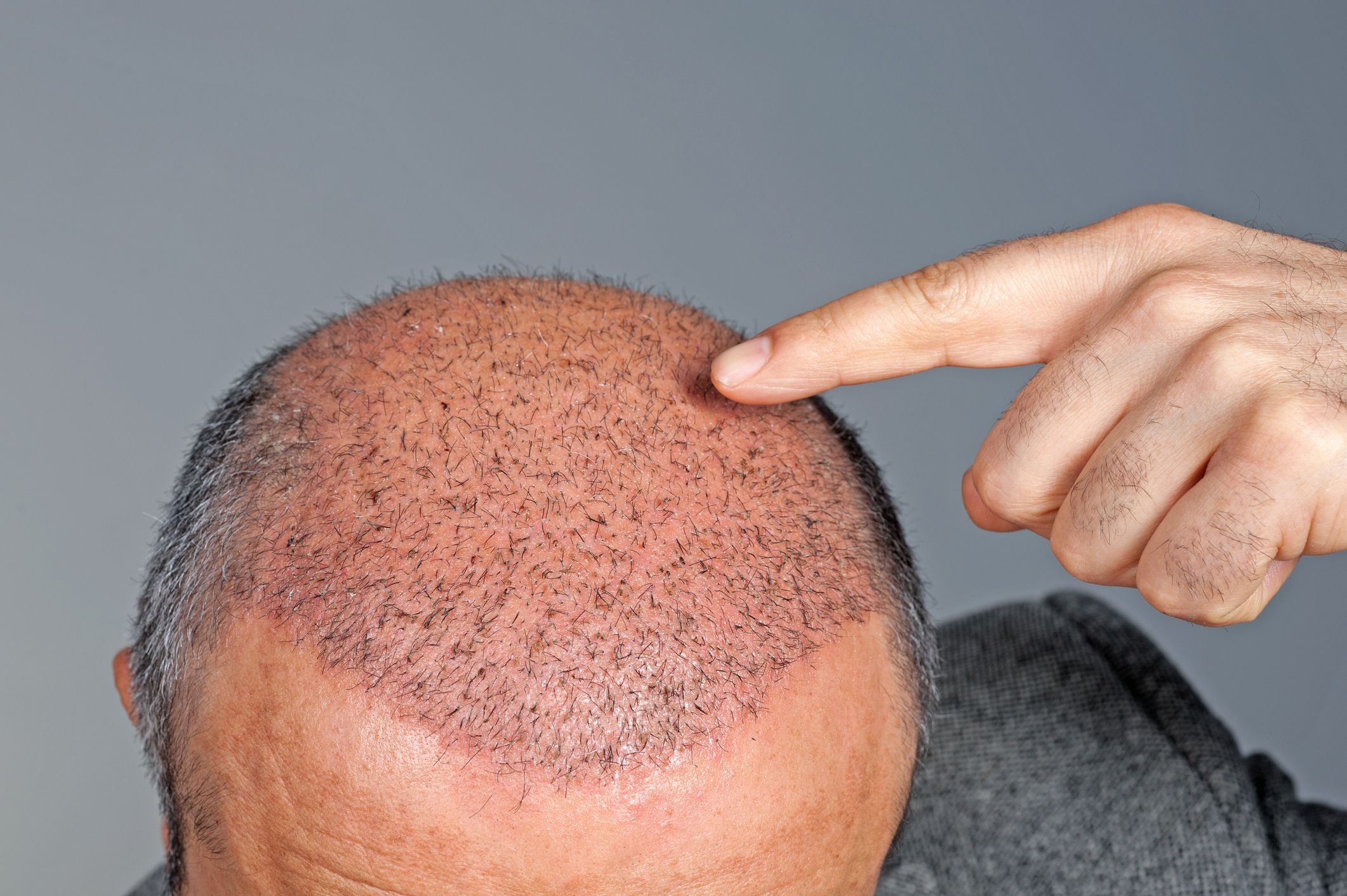 How Effective Hair Transplant is & Its Types - Health Eveready