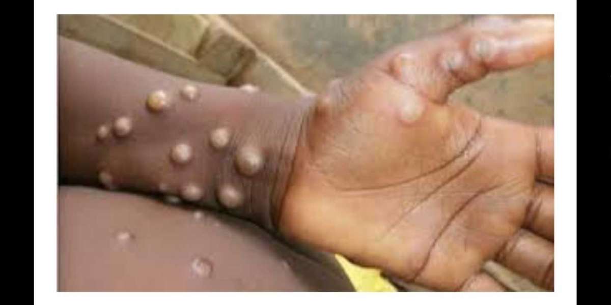 Monkey pox: transmission, signs, medication