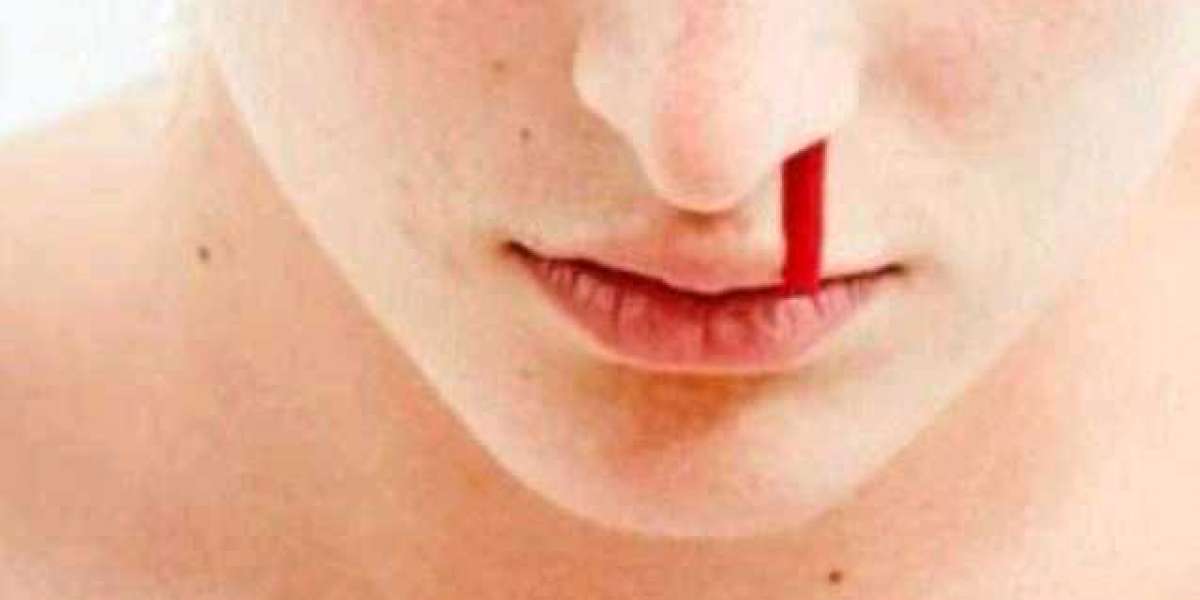 Causes Of Nosebleeds Everyone Should Know