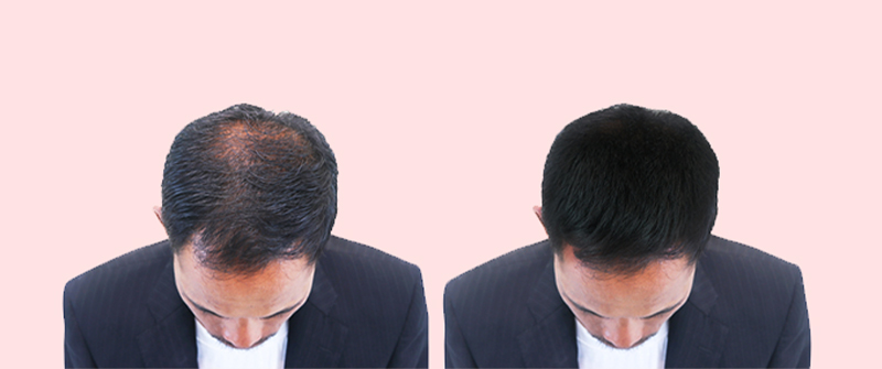 Cheapest Hair Transplant In Delhi | Top Hair Transplant In Delhi