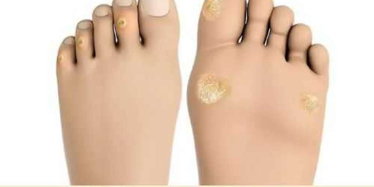 How should corns on the foot be treat from evidence-based medicine?