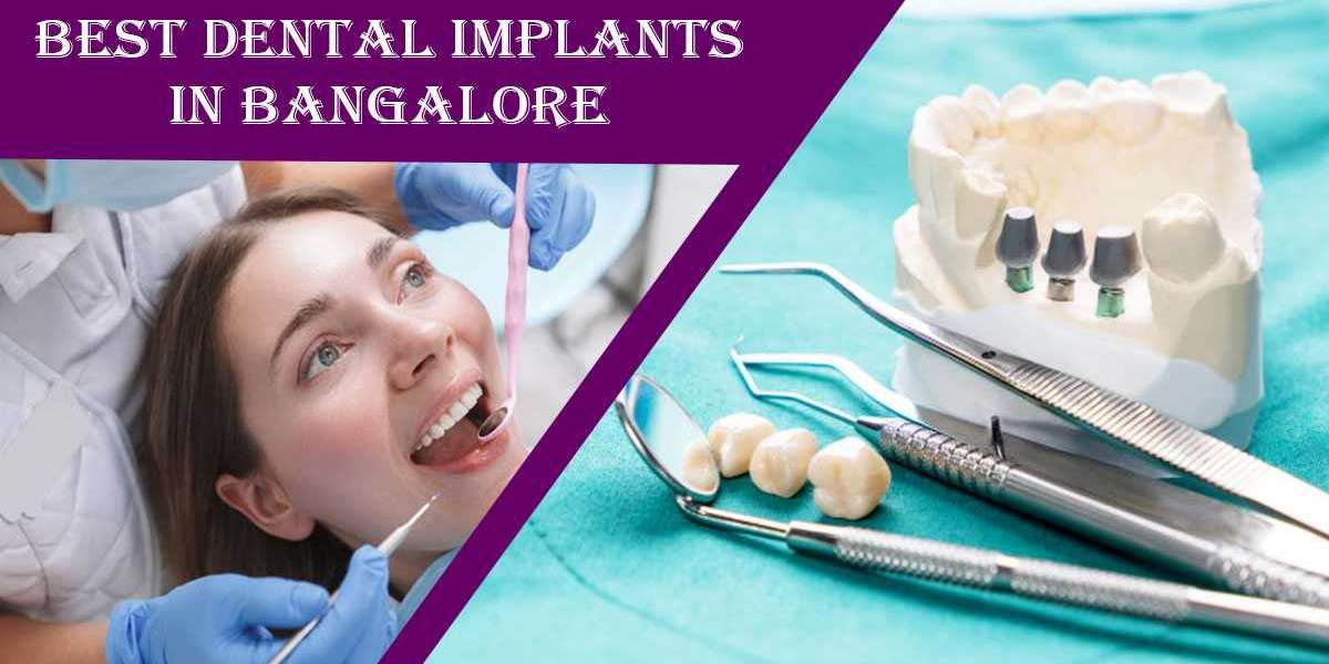 Best Dental Implants in Bangalore | Best Implantologist