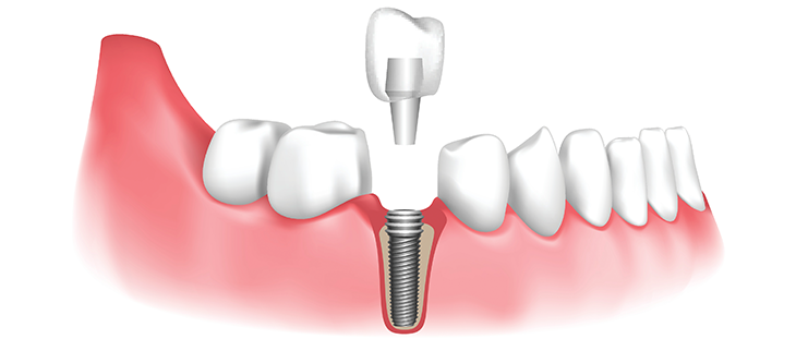 Things To Share With The Best Implant Dentist In Delhi - resistancephl.com