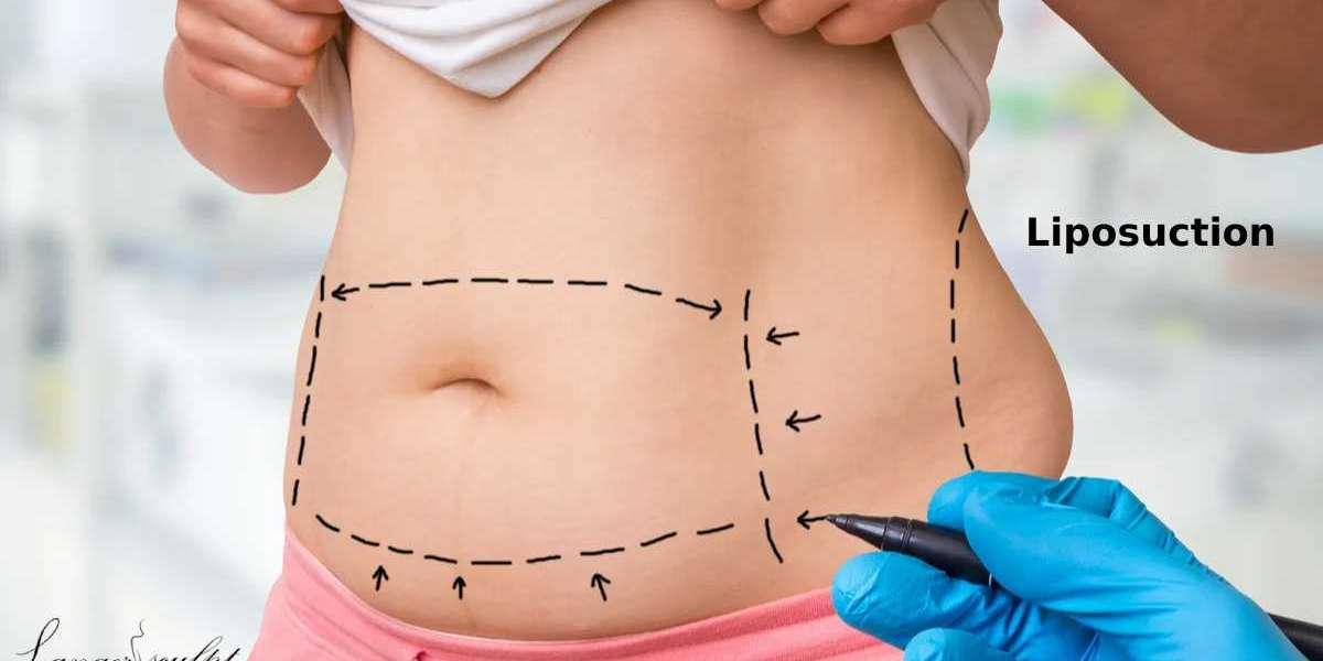 Liposuction For A Wow Body Contour!