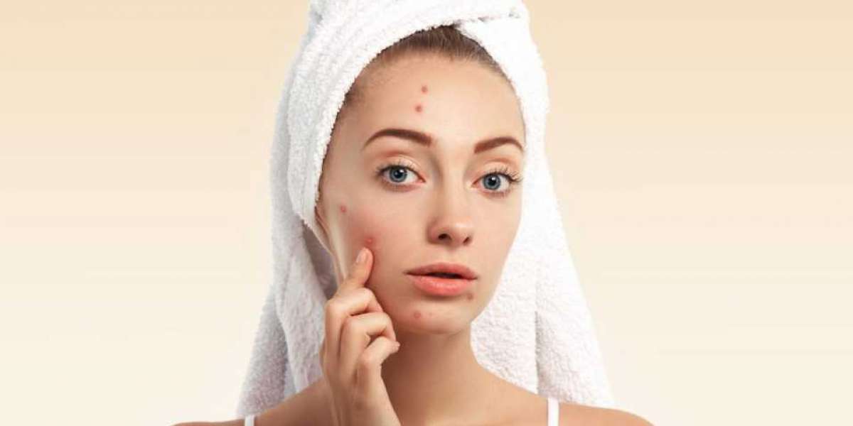 10 Effective Treatments for Acne That You Can Do At Home