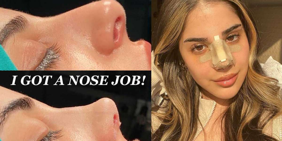 Surgical Nose Job: Getting a Nose Job