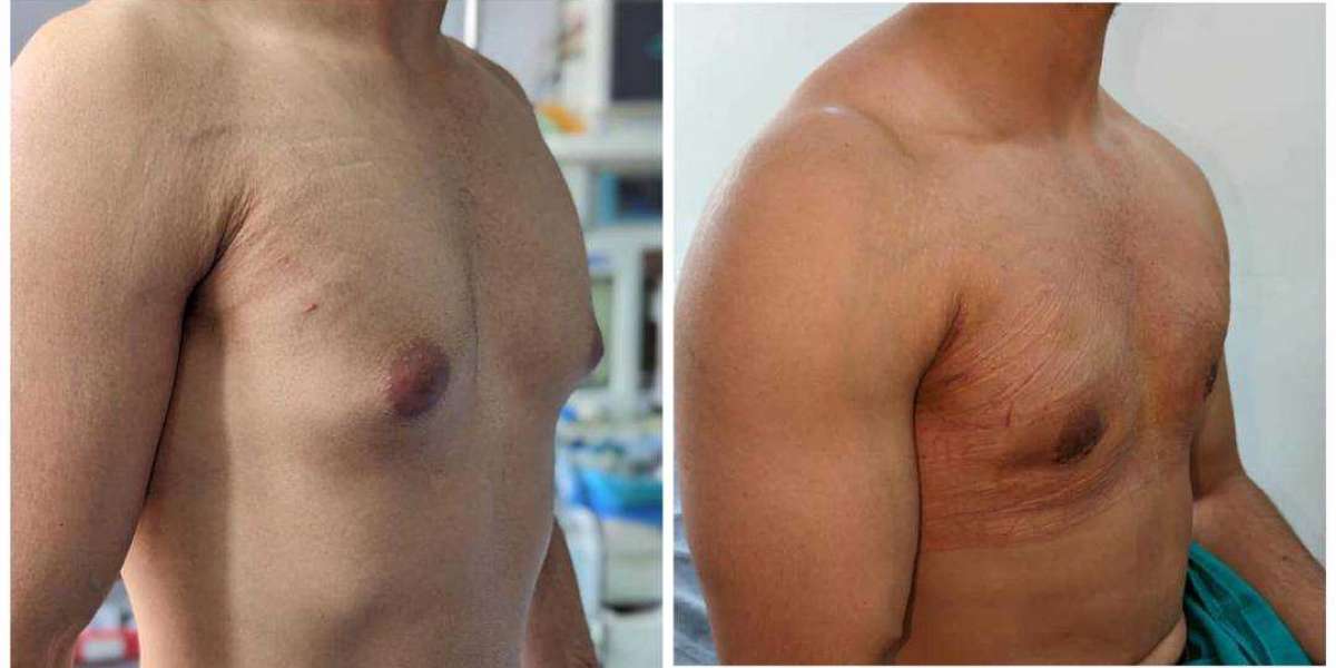 Which surgeon is best for gynecomastia?