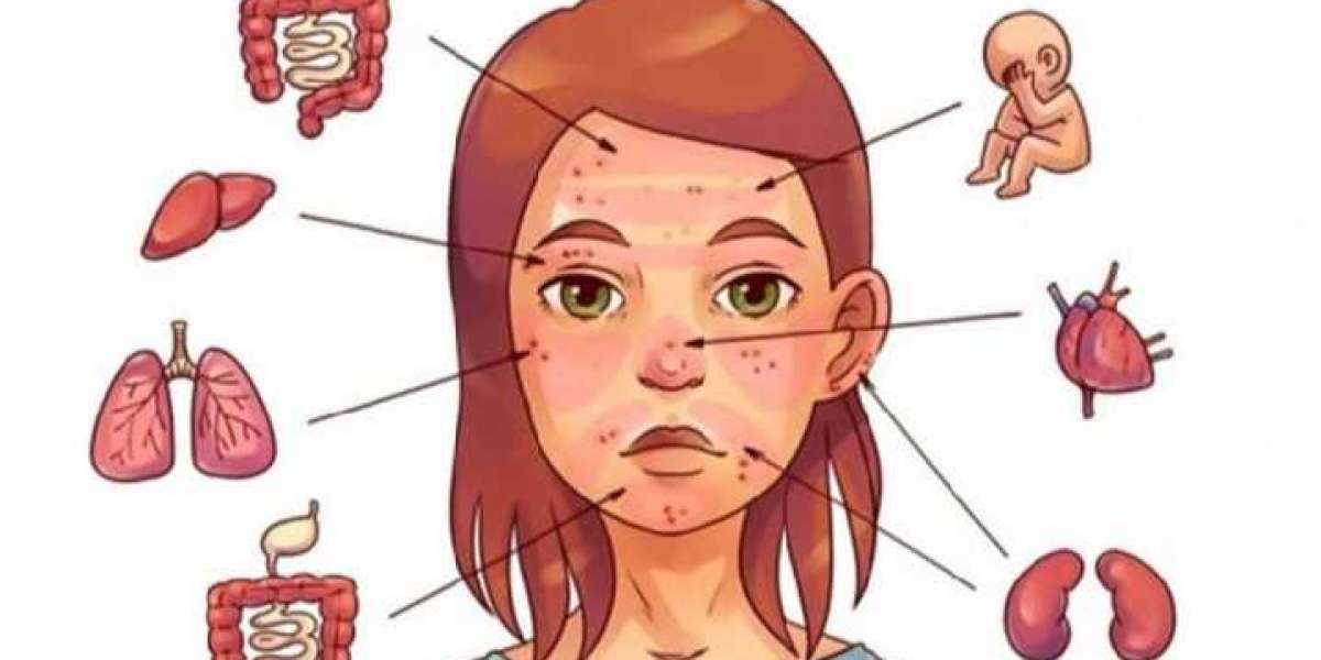 6 Internal problems that cause pimples on your face.