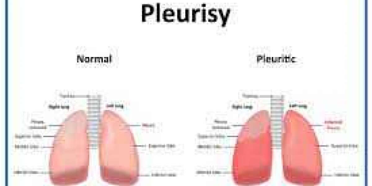 Pleurisy, also known as pleuritis