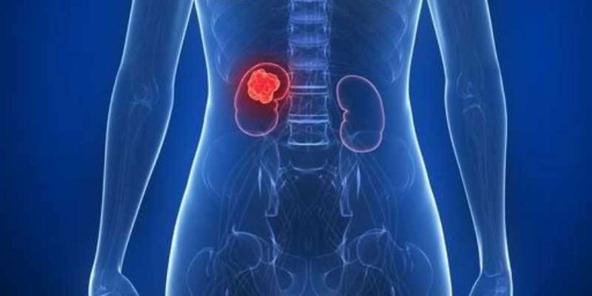 Kidney Cancer: Symptoms, Treatment & More