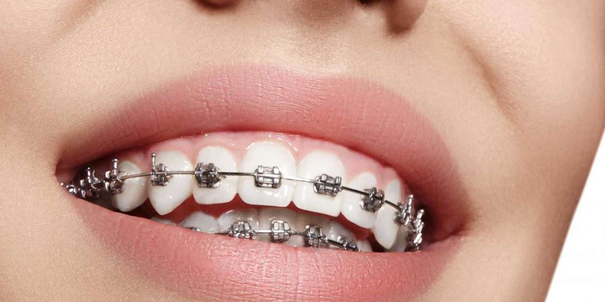 How To Know If You Have A Good Orthodontist For Braces?