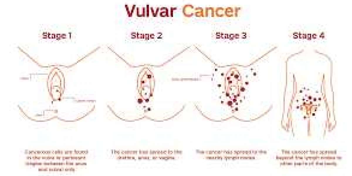 Understanding Vulvar Cancer: Symptoms, Causes, Treatment, and Prevention