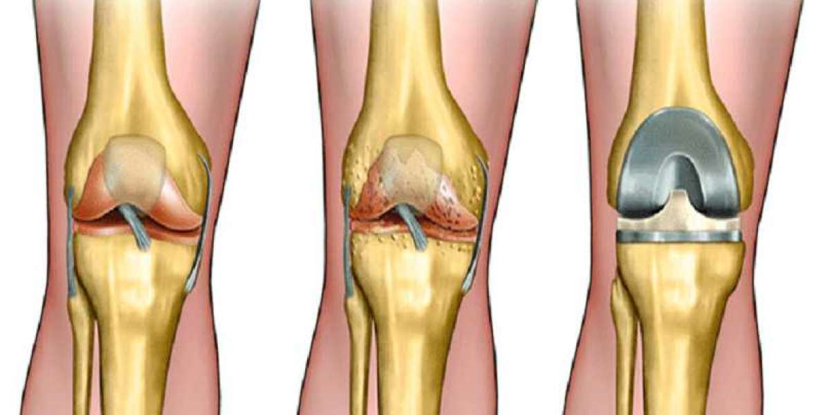 Dr. Rahul Jain | Best Knee Replacement Surgeon in Faridabad