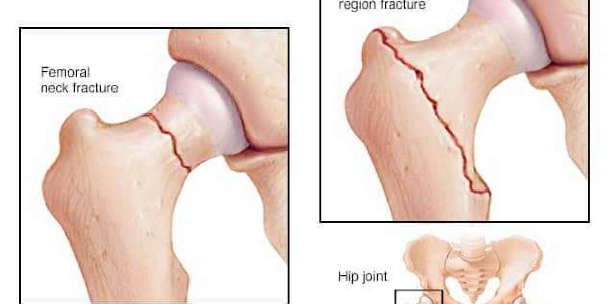 Complications of hip fracture
