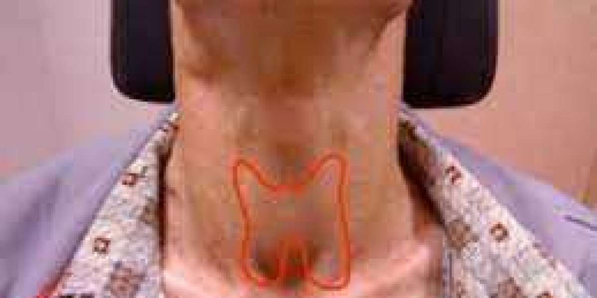 Thyroid Cancer: Symptoms, Causes, Treatment, and Prevention