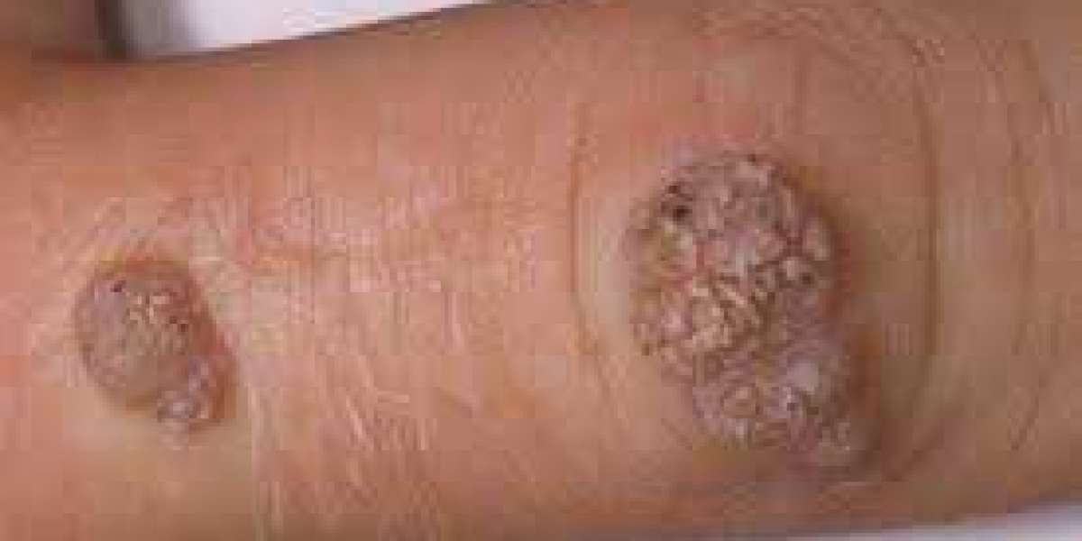 Warts and Verrucas: Causes, Symptoms, Treatment, and Prevention