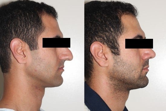 Rhinoplasty Surgery in Delhi to Intensify Your Facial Look | by Dr. Ashish Khare | Mar, 2023 | Medium