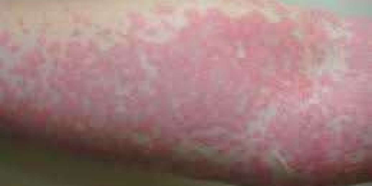Urticaria (Hives): Symptoms, Causes, Treatment, and Prevention
