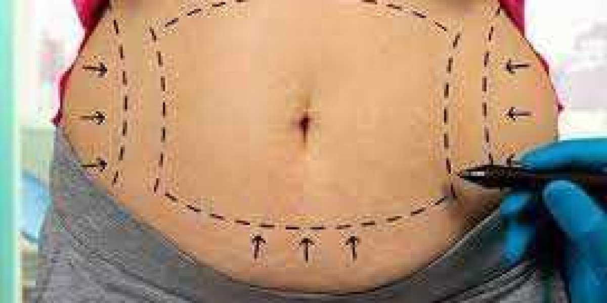 Get Rid of Stubborn Belly Fat with Abdominoplasty