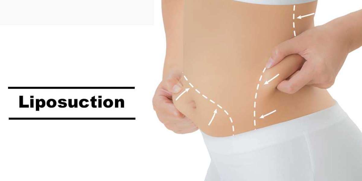 Liposuction Treatment: A Guide To Achieve Your Body Goals
