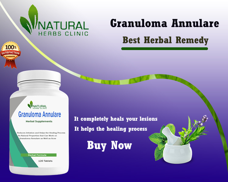 Home Cure for Generalized Granuloma Annulare Treatment Natural