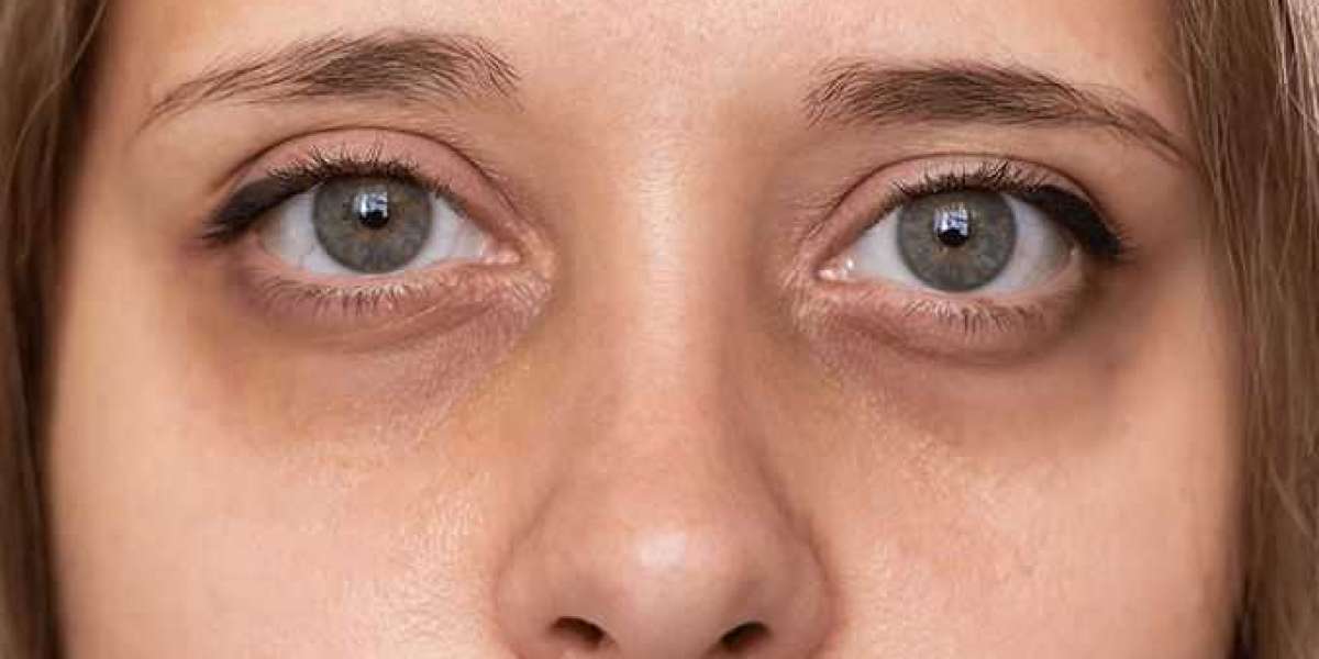 The Truth About Dark Circles: Dispelling Myths and Offering Solutions