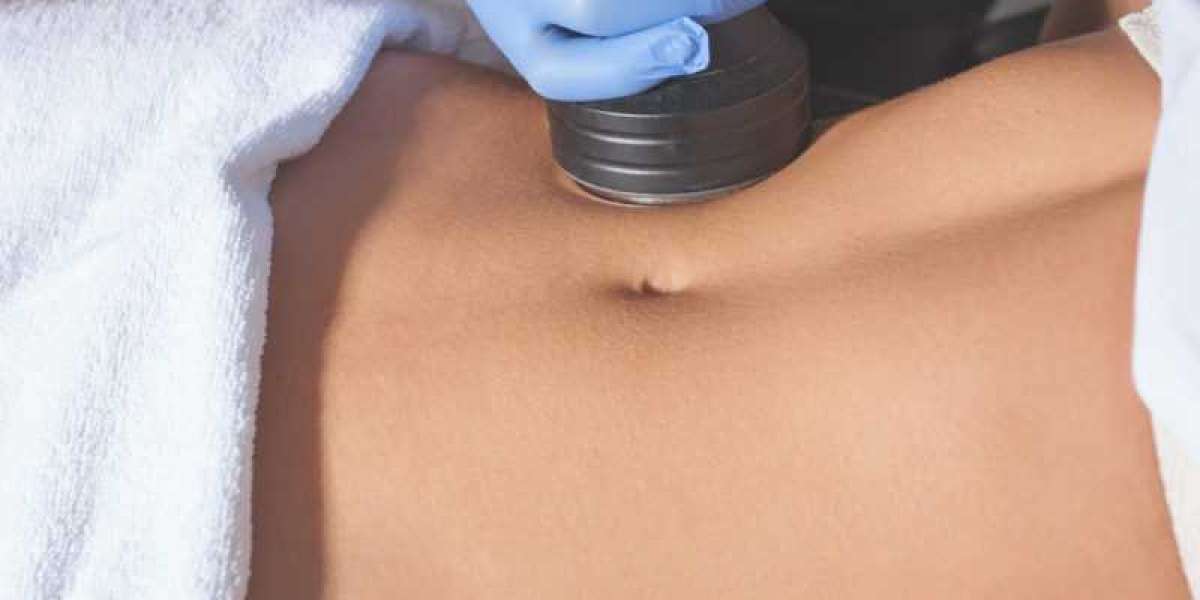 What to Expect From Your Laser Lipo in Sanford Treatment