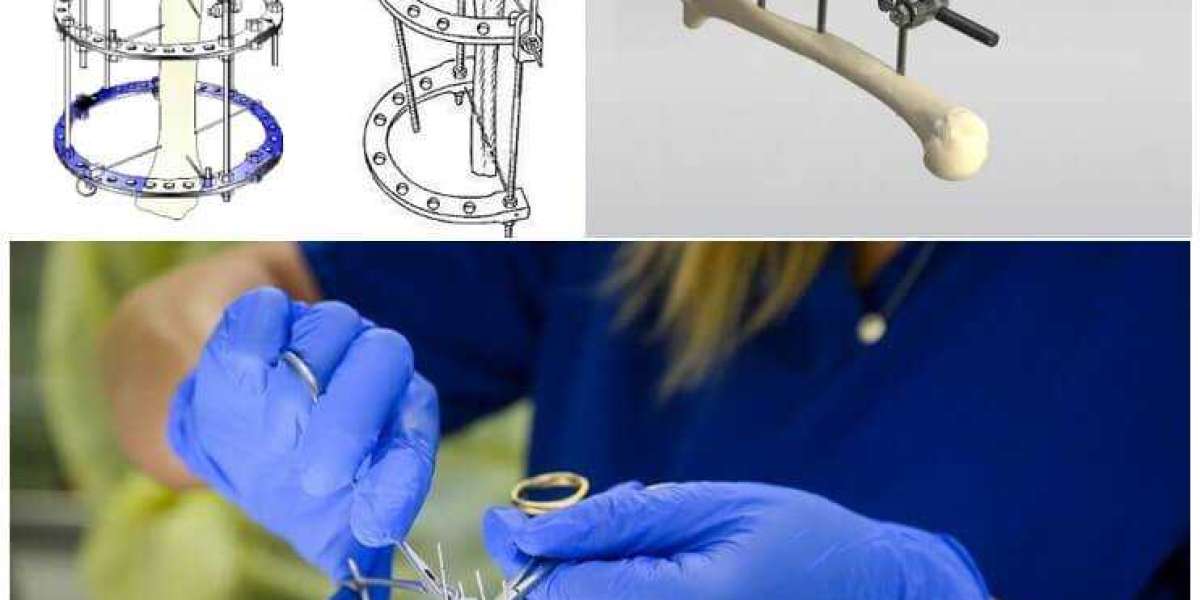 Osteosynthesis Devices Market Size, Share, Trends, Growth & Industry Overview 2023-2028