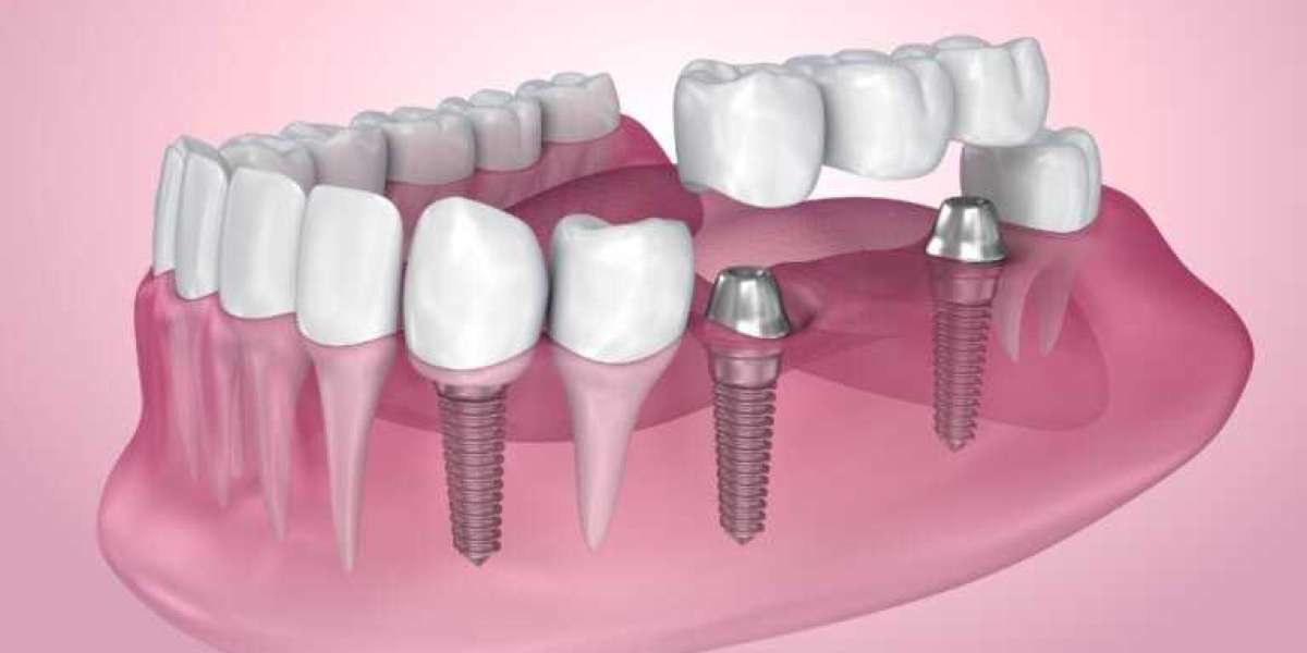 Enhance Your Smile with High-Quality Burlington Dental Implants