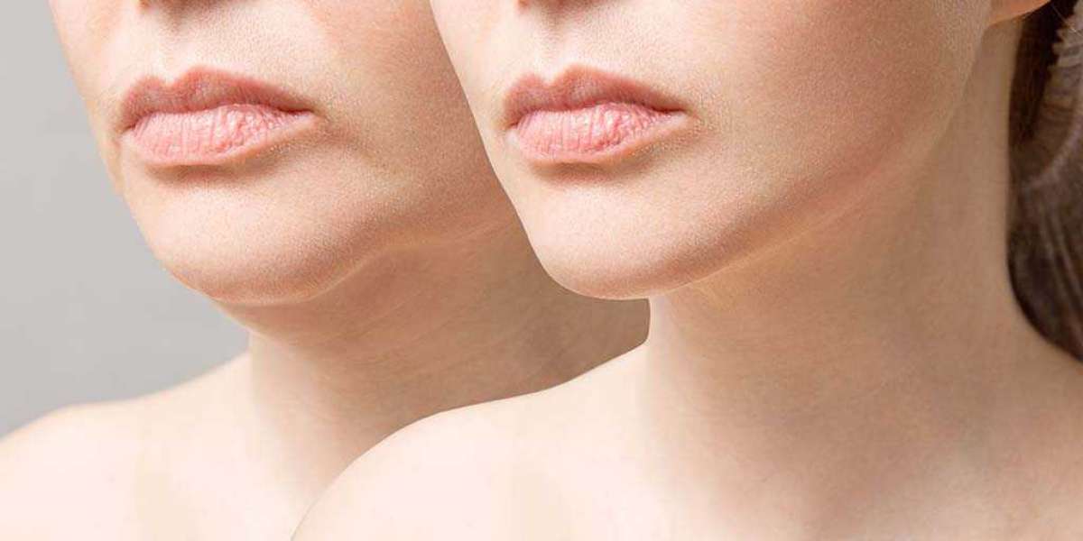 Your Guide to Achieving Natural-Looking Results with Dermal Fillers in Honolulu