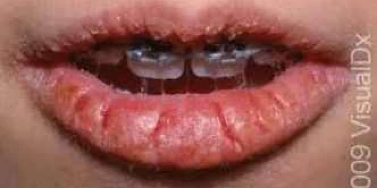 Revealing the Offenders Behind Dry and Dried Lips