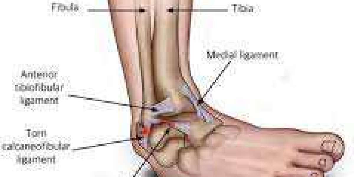 How to Effectively Treat Ankle Injuries: A Comprehensive Guide