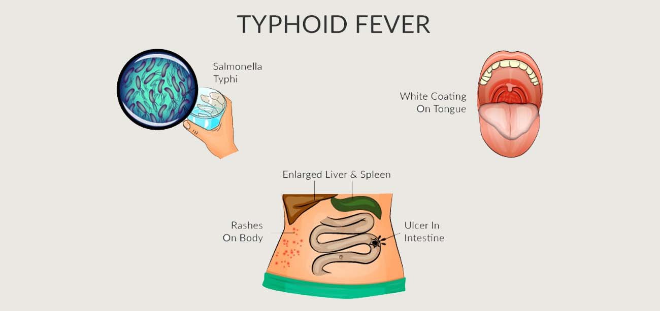Typhoid - 247homeopathy