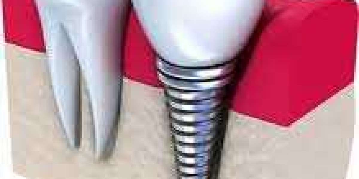 The Procedure of Dental Implant Location