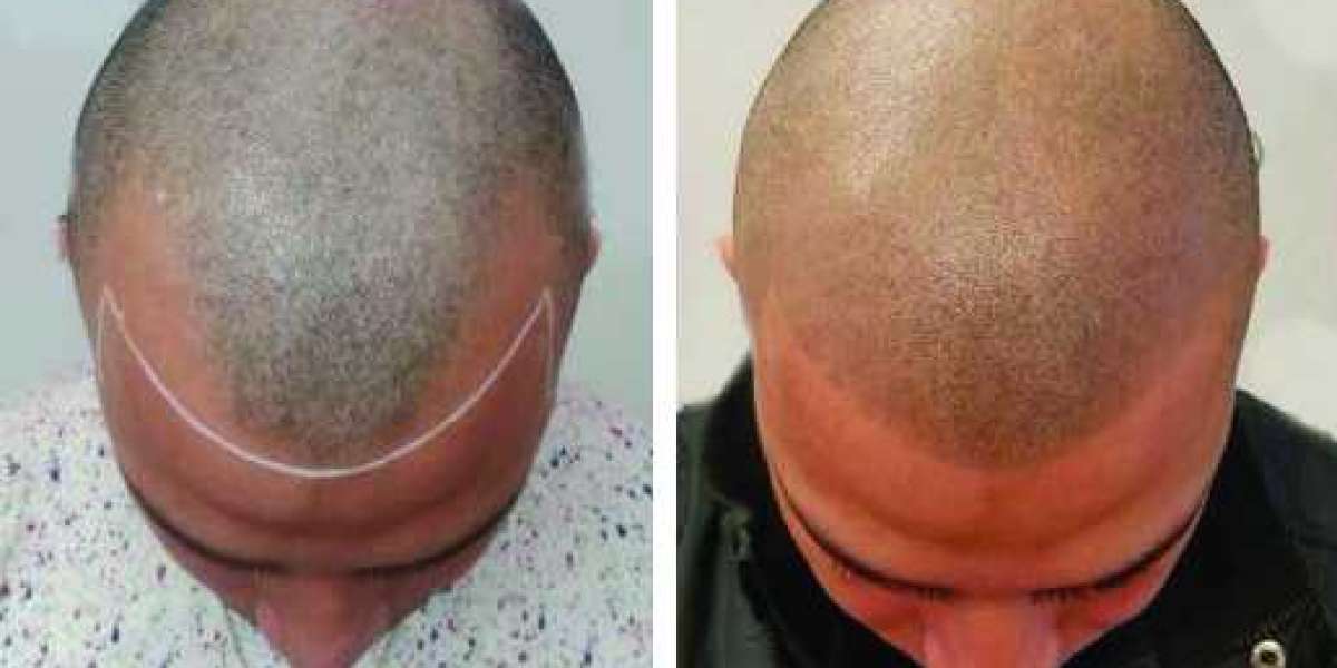 Unlocking the Secrets of Scalp Micropigmentation Treatment in Dubai