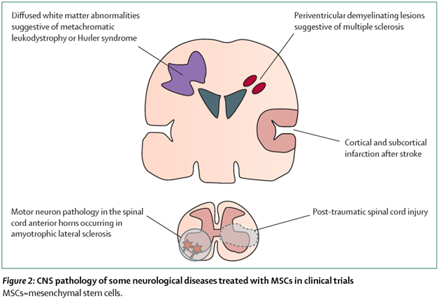 Mesenchymal Stem Cells in Multiple Sclerosis | Kosheeka