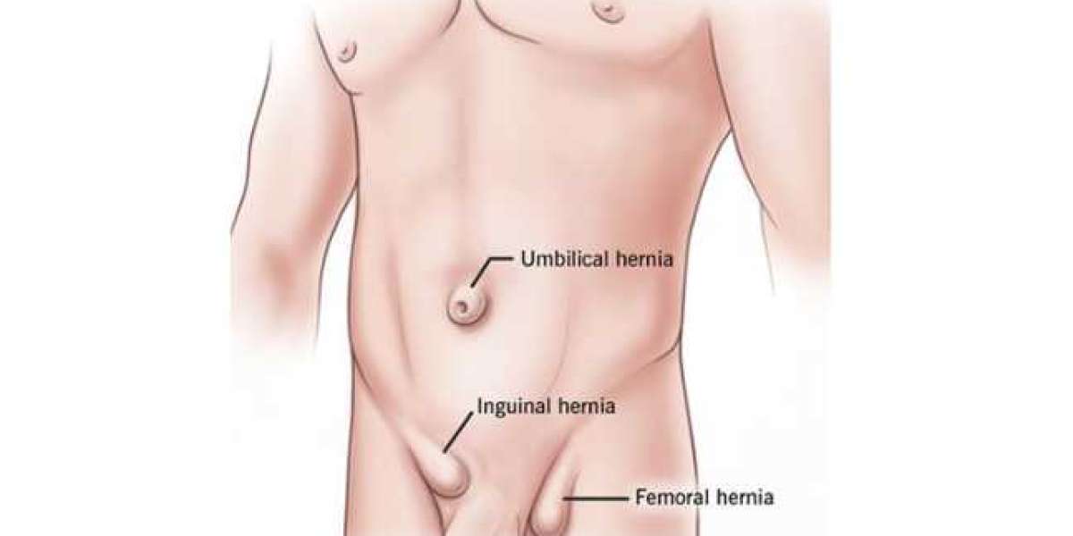 Discover Excellence in Hernia Care with Dr. Tarun Mittal in Delhi