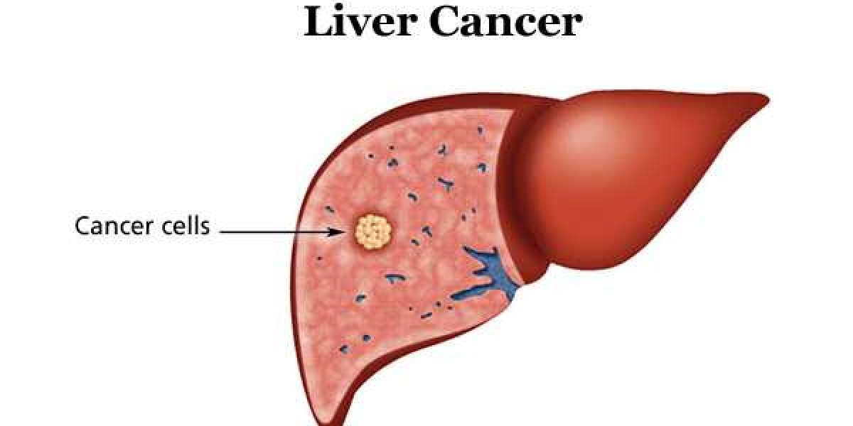 Liver cancer doesn't spell the end of the world, and here's why.