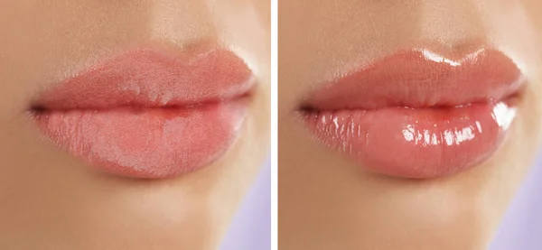 The Ultimate Guide to Revanesse Versa Lip Fillers at VIP Aesthetic Center