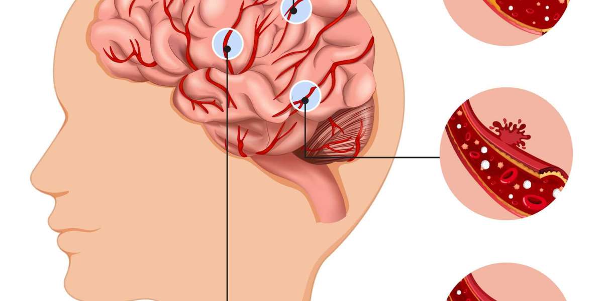 Types of Brain Tumors: Unraveling the Twinkling Feeds