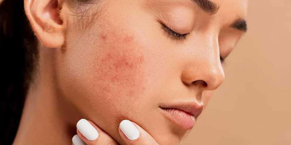 Revitalize Your Skin: Acne Treatment Approaches in Singapore