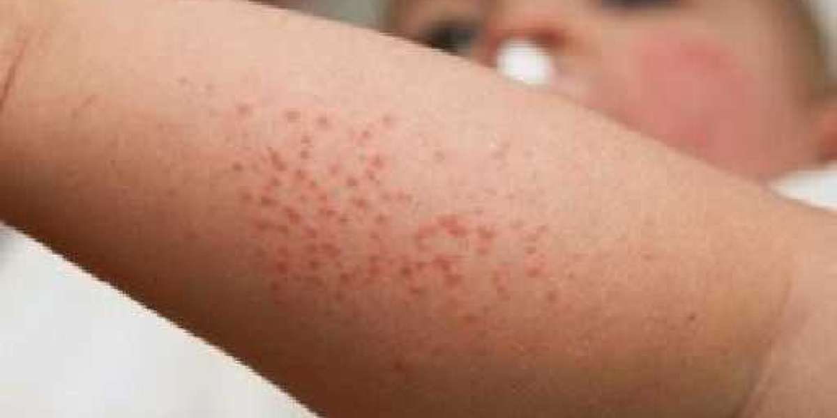 Egg Allergy Market Overview by Advance Technology, Future Outlook 2030